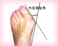 外反母趾のチェック