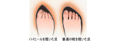 外反母趾の原因