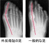 外反母趾の診断